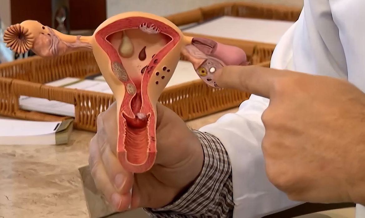 Edital do CNPq vai financiar pesquisas sobre endometriose