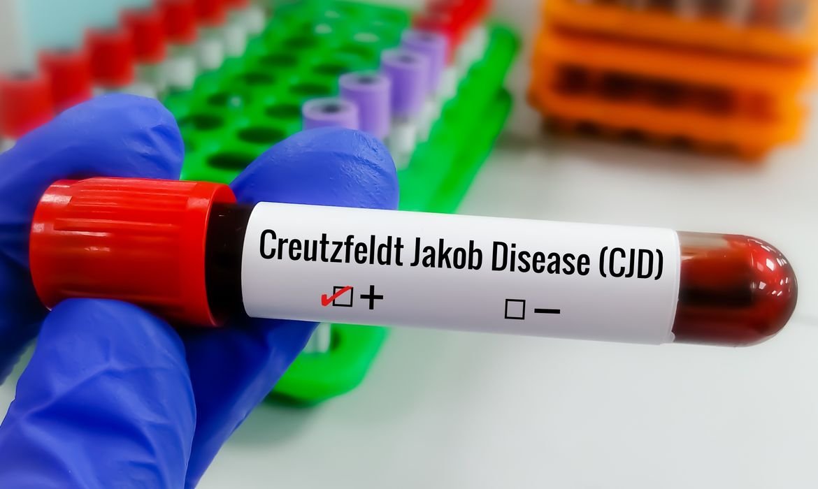Creutzfeldt-Jakob provoca degeneração cerebral progressiva