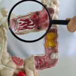 Doenças intestinais crescem e tratamento pode durar décadas