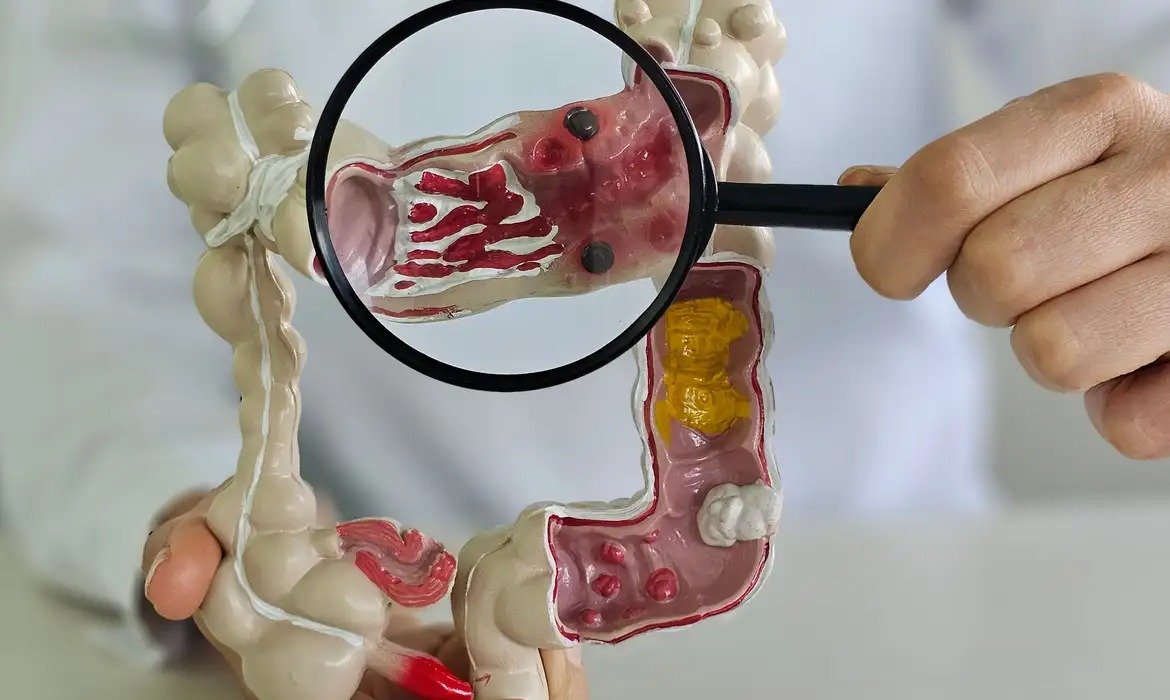 Doenças intestinais crescem e tratamento pode durar décadas